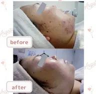 《長年の悩みのニキビ跡！根本からケアで憧れの陶器肌に☆》ニキビ跡ケア！フェイシャル２回体験　[大阪城北詰駅/京橋駅]