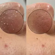 特別価格✨【皮脂分泌の増える季節】いちご鼻とさよなら👃🍓小鼻美人へ✨