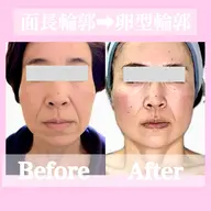 🟡 4/11土曜日 施術モデル様募集【たるみ改善Vリフトフェイシャル】無料撮影モデル募集🔴ご利用条件要確認