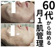 【シワ・ハリつや改善】ハーブピーリング×スピキュール