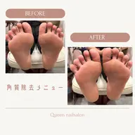 【🉐フット定額】角質除去