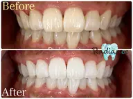 【人気No.1】初回15分3回照射🦷一気に白く!オーダーメイドセルフホワイトニング🦷確実に白くしたい方にオススメ!