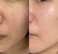 毛穴悩みの方に1番人気☆《毛穴徹底ケア》スチームマッサージ&超音波エステ(毛穴専用パック付き)