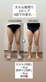 1周年記念キャンペーン 冷却痩身2カップ🧊お好きな箇所どこでも⭕️