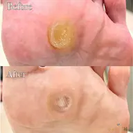 【魚の目ケア】朗報✨【🉐2回目以降もずっと"施術料が500円🉐】足裏ゴワゴワ痛〜い魚の目をキレイな足裏へ💁♀️