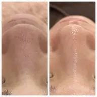 【毛穴洗浄】毛穴ごっそりお掃除コース