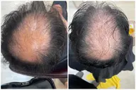 水素スパ🧖‍♀️間葉系幹細胞配合！！