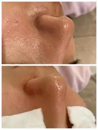 毛穴洗浄フェイシャル＆PDRNサーモンDNA美容液導入　角質&毛穴をごっそりツルツルに