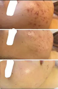 【剥離あり】ハーブピーリング🌿毛穴ニキビケア、肌別パック付🩵本気で肌質改善したい方にオススメ✨ダウンタイムあり😌