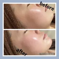 【目指せ水光肌！】ハーブピーリング