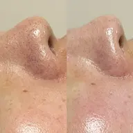 🪨【黒ずみ毛穴つるん！ふわふわ毛穴へ】REVIハーブピーリング《陶肌トリートメント》 ➕ エンザイム1g