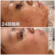 【満足度驚異の98%⁉️】実績6万人の専門店が施す『効果No.1の痛くないピーリング』🔥治らないニキビ跡ならこれ‼️