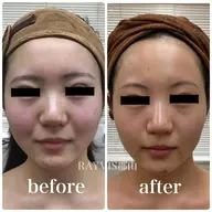 🍓魔法のフェイシャル🍓美白＋小顔＋黒ずみスッキリ✨潤いご褒美フェイシャルたっぷり50分♪デコルテマッサージ付き