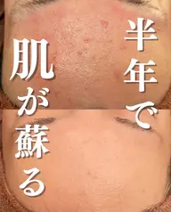 【🌿本日限定🌿】人気メニュー！とにかくニキビ・ニキビ跡をなんとかしたい‼️ピーリング＋W鎮静パック