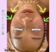 たるみサヨナラ宣言フェイシャル