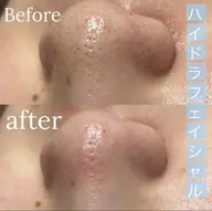 練習モデル☆全顔ハイドロ毛穴洗浄×顔脱毛セット♪