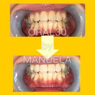 セルフホワイトニング2回目以降