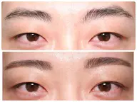 【メンズ歓迎】アイブロウ脱毛トリートメント