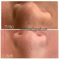 ⇧人気急上昇⇧小鼻集中エステ