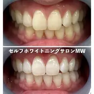 【ご新規様限定★】スタンダードコース🦷✨​〜​黄ばみや汚れをごっそり落とす​〜​(15分×2照射)