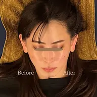 美容鍼体験+肩こりスッキリコース