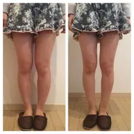 キャンペーン🔥脚痩せセルライトケアコース✨ ⭐️1ヶ月以内施術2回分