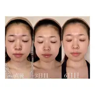 本気の肌質改善お手伝いします👌🏻毛穴ひらき ザラつき ニキビ跡 美白 たるみ 浮腫…おまかせ下さい🙆♀️