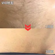 【ミニモ学割】VIO脱毛