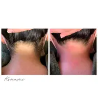 【WAX脱毛】お祭りや前撮り前に🩵うなじ美人