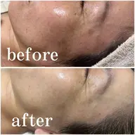 美肌リンパトリートメント+韓国最新ララピール