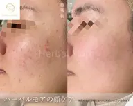 【期間限定40%オフ】ハーブピーリング【顔】剥離あり、無し選べる！ニキビ、ニキビ跡、凹凸、黒ずみ、men'sも大歓迎！！