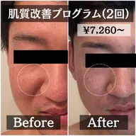 【肌質改善プログラム2回セット】トライアル化粧品一式プレゼント付♪90分¥33550→¥21340