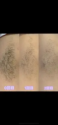 最速実感⭐︎全身脱毛【乗り換え割有・敏感肌OK🫧】