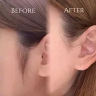 WAX脱毛(もみあげ、口周り、鼻、おでこ)の内いずれか1箇所