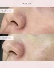 【毛穴ワックス脱毛】ポツポツ、黒ずみとさようなら