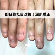 長年悩んでいた深爪も、即日見た目改善！深爪の方のみお受けできます。ベテランスタッフによる、深爪矯正メニューの練習モデル
