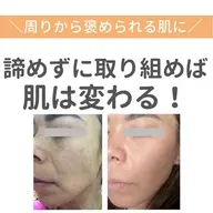 【たるみ・たるみ毛穴ケア】ラジオ波＆人幹細胞培養液のポレーションでたるみに革命！！最新ケアで年齢サインを徹底リセット。