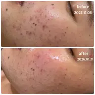 【メンズエステ】限定！《エンザイムパウダー追加》毛穴・くすみケアに特化！！ターンオーバー促進透明感のあるお肌へ