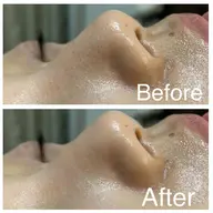 【憧れの美肌小顔✨】Vライン骨格小顔💎＋つるつるタマゴ肌へ👸《毛穴/テカリ/ハリ/肌荒れ/乾燥》