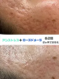 徹底改善☆ピーリング　【ニキビ痕/色素/シミ/しわ/角質除去/凹凸/ゴワつき】ローズドメーラ×アンストレス💎