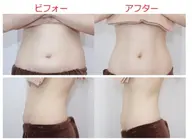 【ご新規様限定】✨全身デトックス✨ハイパーナイフ&オールハンドリンパドレナージュ！ハイパーナイフスリム！贅沢に160分！