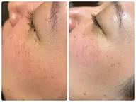 【角質・産毛除去で滑らかな肌へ】フェイシャルシェービング