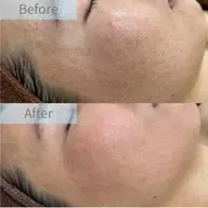 【肌管理診断】❄️目指せ陶器肌✨毛穴洗浄＋小顔＋保湿＋美白💘トラブルレス肌へ