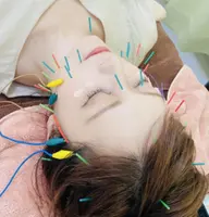 美容鍼プレミアム【電気✖︎頭皮鍼でリフトUP⤴️】