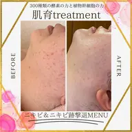 陶肌トリートメント小顔 毛穴洗浄コース🫧