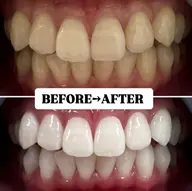 学割U24【お得な5回コース】美白ホワイトニング20分×10回 ¥22,000