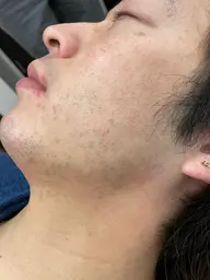 メンズヒゲ脱毛