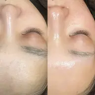 ［モニター限定📸］特別クーポン🌼minimo限定🩷フェイシャル脱毛ワックス×産毛や角質除去 ✨即日効果あり⭕️