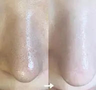 毛穴撃退コース✨【ハイドラ✖️炭酸✖️プラズマ】皮脂黒ずみつまり開きが気になる方にオススメ🤍