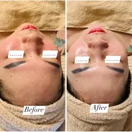 シミ美白ピーリング